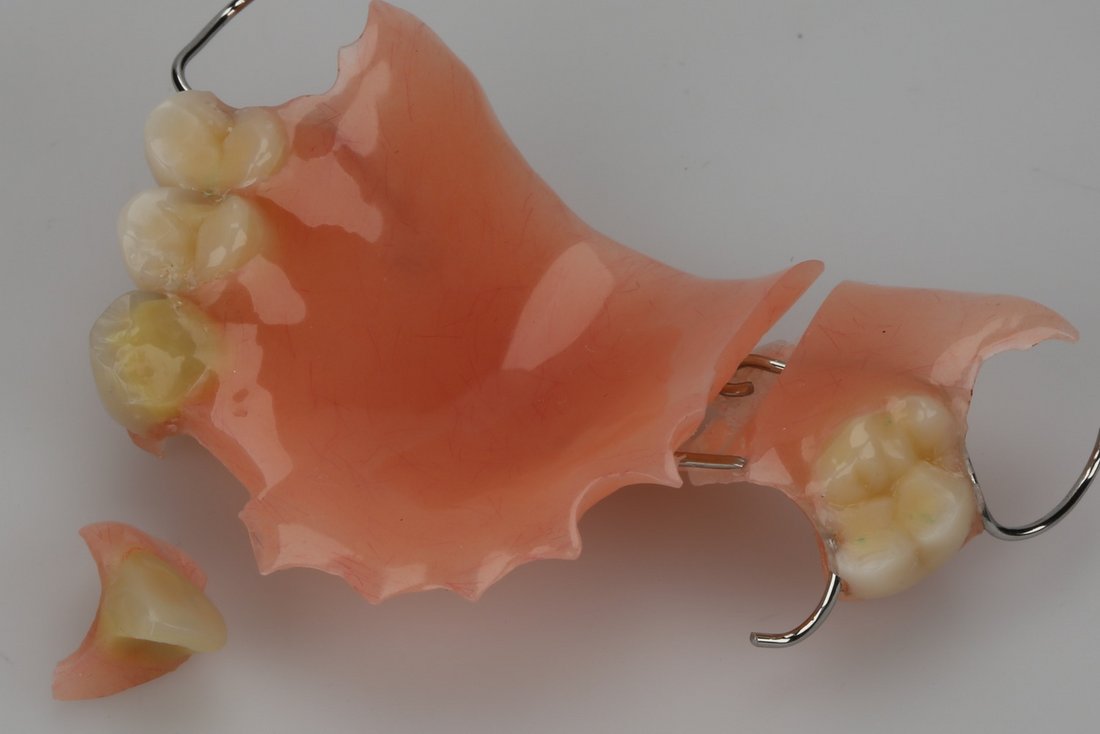 Teilprothese gebrochen, Dental-Studio Bern
